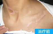 额头白癜风治疗前案例图