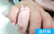 脚部白癜风治疗前的案例图