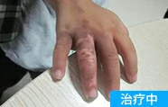 脚部白癜风治疗中的案例图