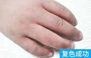 脚部白癜风治疗后的案例图