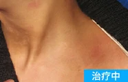 额头白癜风治疗中案例图