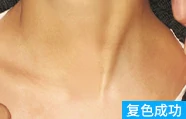 额头白癜风治疗后案例图