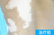胯部白癜风治疗前的案例图