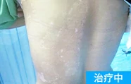 胯部白癜风治疗中的案例图
