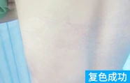 胯部白癜风治疗后的案例图