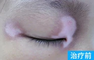 发展期白癜风治疗前的案例图
