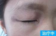 发展期白癜风治疗中的案例图