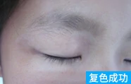 发展期白癜风治疗后的案例图